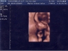 3d-20-week-ultrasound-1.jpg