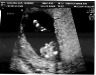 13-week-ultrasound-2.jpg